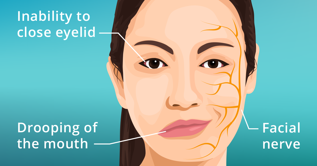 Bell’s Palsy treatment  in Kurukshetra