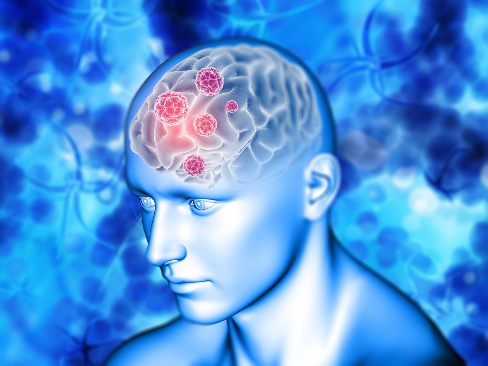 Motor Neurone Disease Treatment Doctors in Kurukshetra